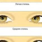упражнения при косоглазии