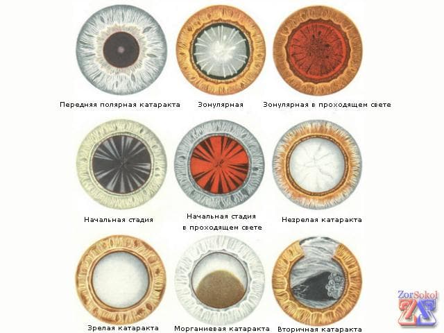 виды катаракты