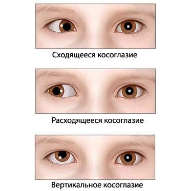 Виды косоглазия