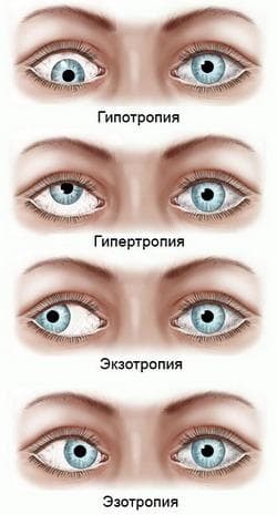 Виды косоглазия
