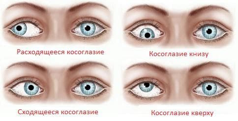 виды косоглазия