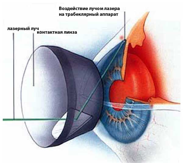 vidy-lazernogo-lecheniya-glaukomy