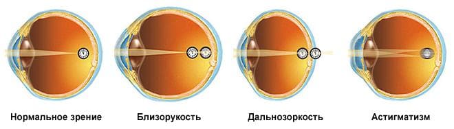 виды патологий зрения