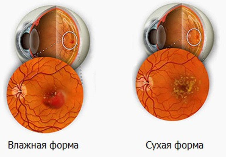влажная и сухая формы отслойки сетчатки