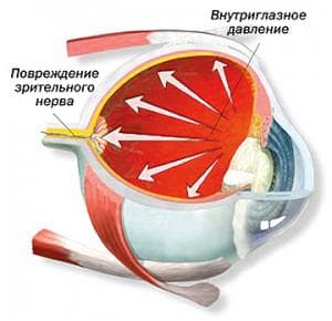 внутриглазное давление и повреждение зрительного нерва