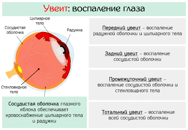 vospalenie-sosudistoj-obolochki-glaza
