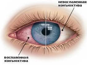 воспаленная конъюнктива