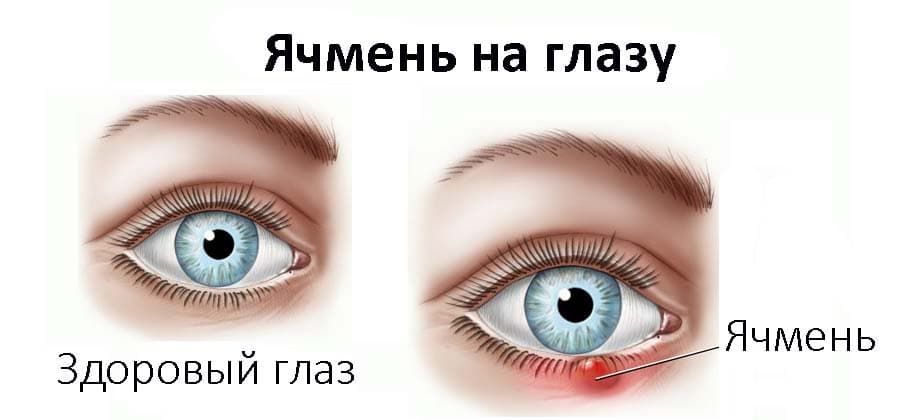 ячмень на глазу лечение