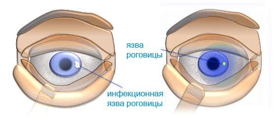 yazva-rogovicy-i-kapli-ofloksacin