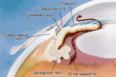 закрытоугольная глаукома