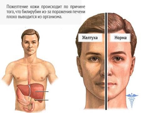 Почему желтеют кожные покровы и склеры глаз