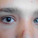 зрачки разного размера причины