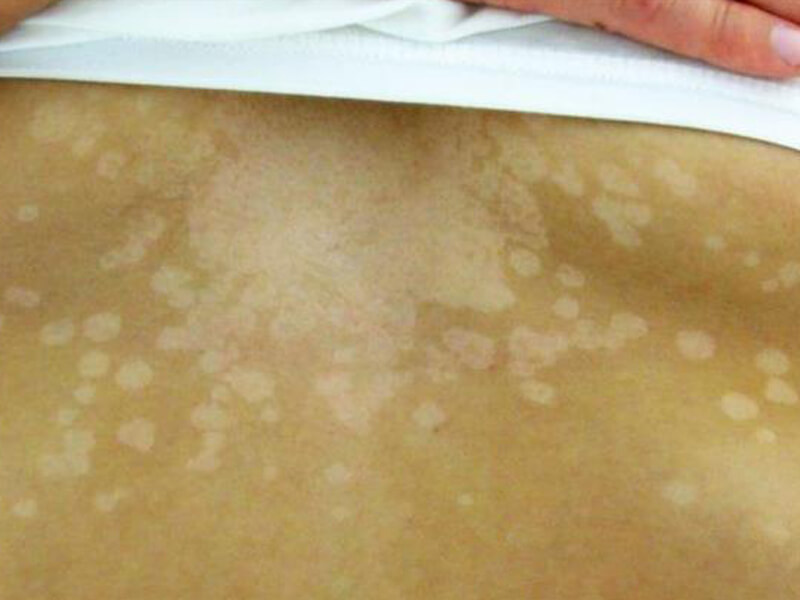 Лишай при беременности виды